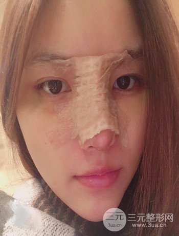 全脸自体脂肪填充+隆鼻整形果永.久保持、丑小鸭变天鹅不是梦
