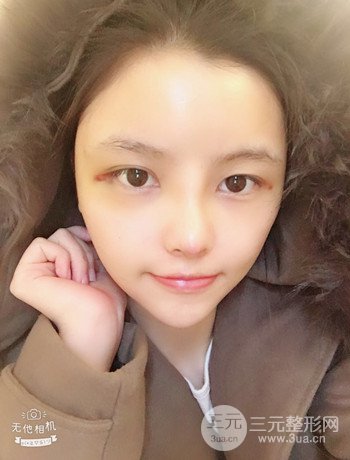 全脸自体脂肪填充+隆鼻整形果永.久保持、丑小鸭变天鹅不是梦