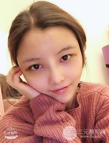 全脸自体脂肪填充+隆鼻整形果永.久保持、丑小鸭变天鹅不是梦