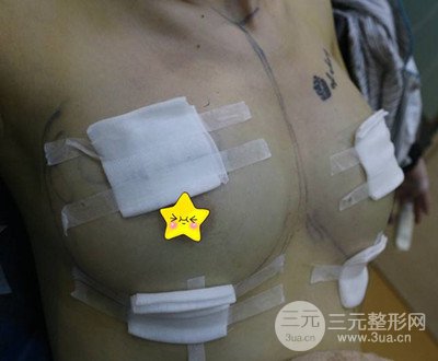 自体脂肪隆胸术后恢复过程分享|成功落实变大胸的愿望