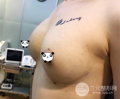 自体脂肪隆胸术后恢复过程分享|成功落实变大胸的愿望