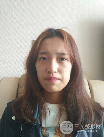 上海面部脂肪填充一个月果超明X、妥妥减龄十岁！