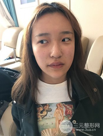 上海面部脂肪填充一个月果超明X、妥妥减龄十岁！