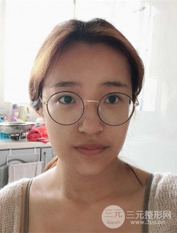 上海面部脂肪填充一个月果超明X、妥妥减龄十岁！