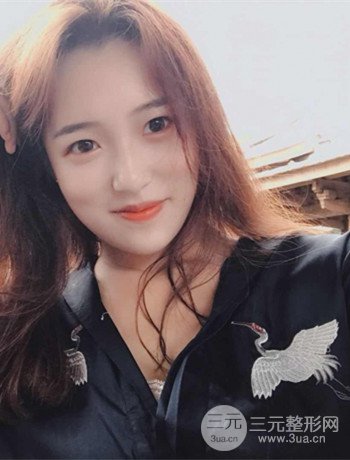 上海面部脂肪填充一个月果超明X、妥妥减龄十岁！