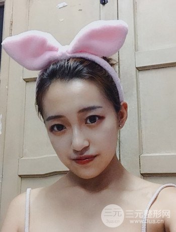 上海面部脂肪填充一个月果超明X、妥妥减龄十岁！