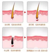 激光脱毛多久做一次