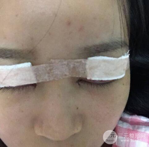 芭比电双眼皮多项整形术后分享，双眼皮拯救死鱼眼！