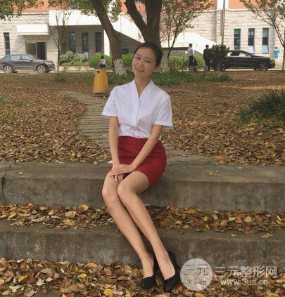 芭比电双眼皮多项整形术后分享，双眼皮拯救死鱼眼！