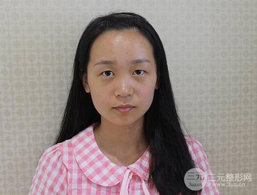 芭比电双眼皮多项整形术后分享，双眼皮拯救死鱼眼！