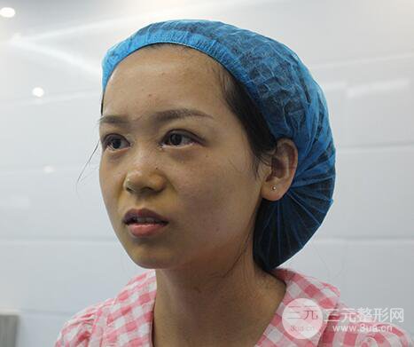 芭比电双眼皮多项整形术后分享，双眼皮拯救死鱼眼！