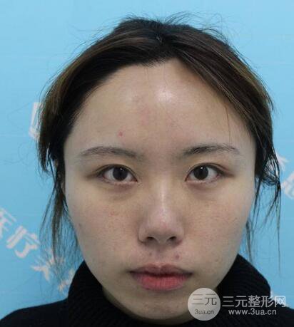 自体脂肪填充全脸基本换脸，改脸型不只是磨骨才能做到！