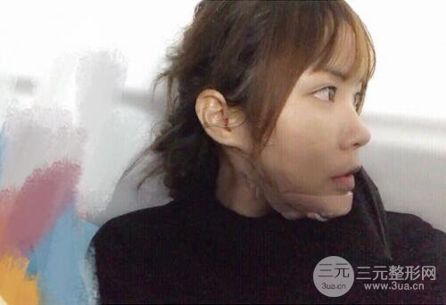 自体脂肪填充全脸基本换脸，改脸型不只是磨骨才能做到！