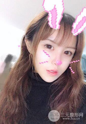 自体脂肪填充全脸基本换脸，改脸型不只是磨骨才能做到！