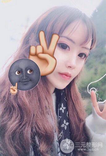 自体脂肪填充全脸基本换脸，改脸型不只是磨骨才能做到！