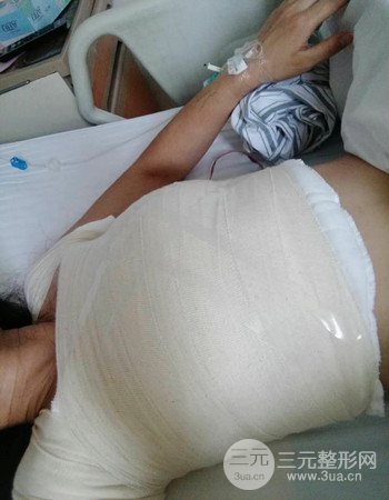 上海假体隆胸真人案例，罩杯从A-到C不是梦