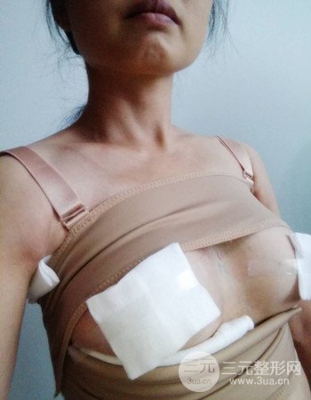 上海假体隆胸真人案例，罩杯从A-到C不是梦