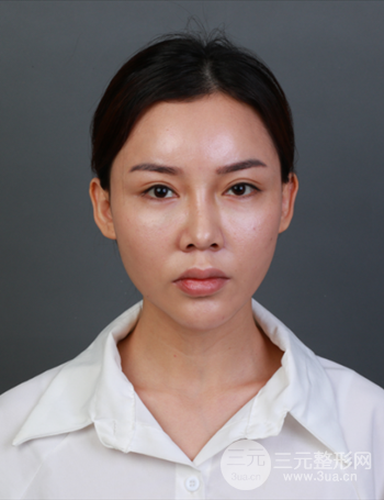 上海隆鼻失败手术修复果超乎想象、前后对比照片分享