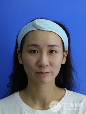 面部埋埋蛋白线.提升改良皮肤松弛，立现小V脸