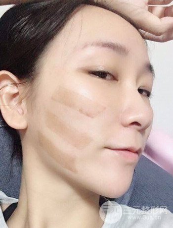 面部埋埋蛋白线.提升改良皮肤松弛，立现小V脸