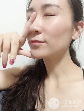 面部埋埋蛋白线.提升改良皮肤松弛，立现小V脸