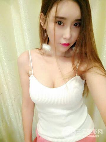自体脂肪丰胸案例