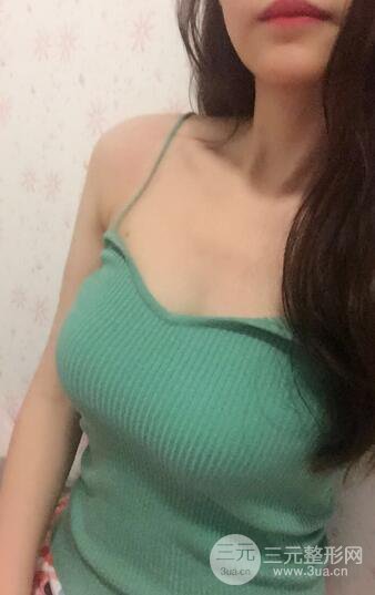 自体脂肪丰胸案例