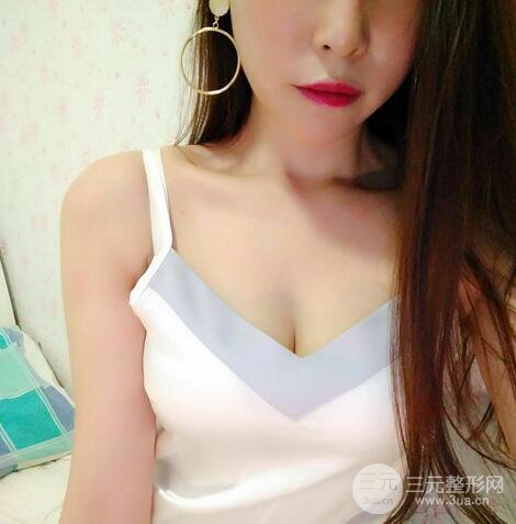 自体脂肪丰胸案例