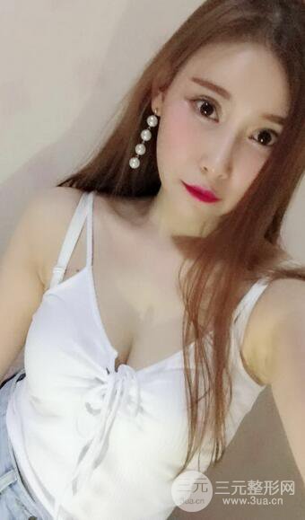 自体脂肪丰胸案例