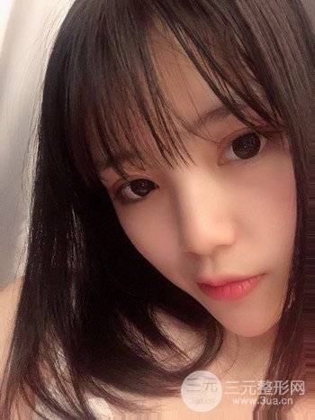 切开双眼皮开眼角果超赞、成功改良大小眼