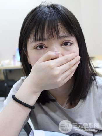 切开双眼皮开眼角果超赞、成功改良大小眼