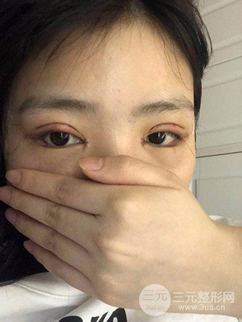 切开双眼皮开眼角果超赞、成功改良大小眼