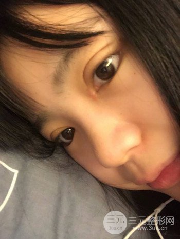 切开双眼皮开眼角果超赞、成功改良大小眼