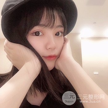 切开双眼皮开眼角果超赞、成功改良大小眼