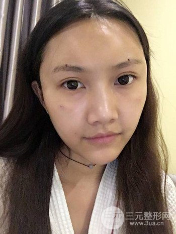 多面部自体脂肪填充前后对比图、果十分惊人