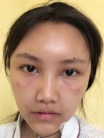 多面部自体脂肪填充前后对比图、果十分惊人