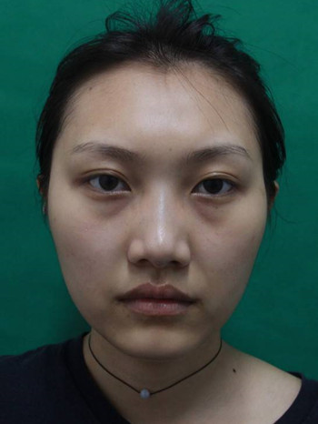 多面部自体脂肪填充前后对比图、果十分惊人