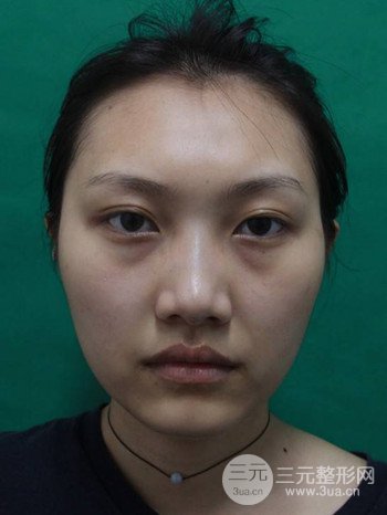 多面部自体脂肪填充前后对比图、果十分惊人