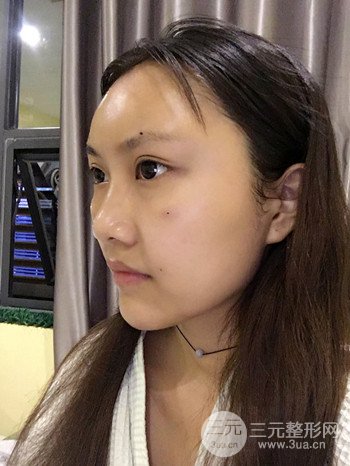 多面部自体脂肪填充前后对比图、果十分惊人