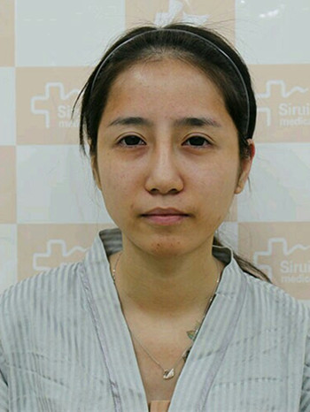 韦文峰自体脂肪面部填充手术案例分享、堪称减龄神器