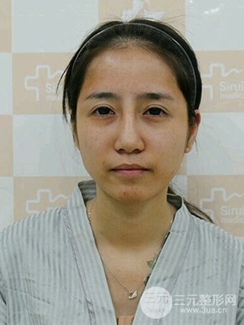 韦文峰自体脂肪面部填充手术案例分享、堪称减龄神器
