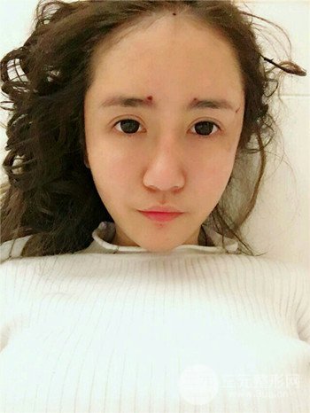 韦文峰自体脂肪面部填充手术案例分享、堪称减龄神器