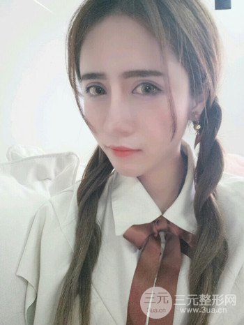 韦文峰自体脂肪面部填充手术案例分享、堪称减龄神器