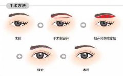 如何避免切眉手术的后遗症