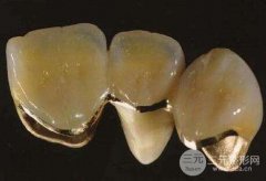 半贵金属烤瓷牙价格