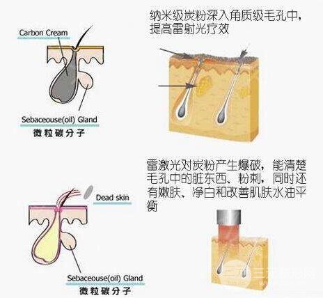黑脸娃娃适合什么人做?黑脸娃娃术前准备5步走!