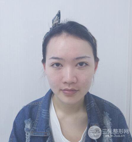 耳软骨隆鼻全过程及术后果分享