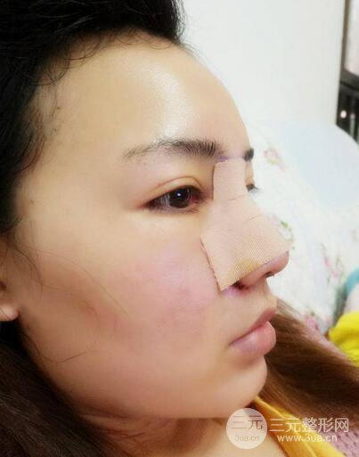 耳软骨隆鼻全过程及术后果分享