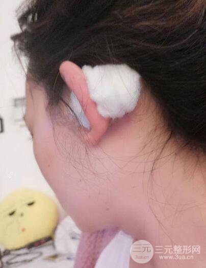 耳软骨隆鼻全过程及术后果分享