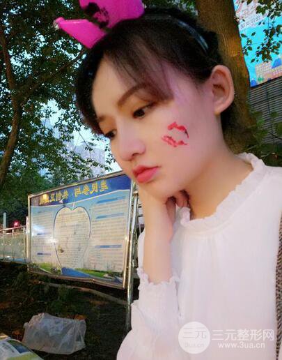 耳软骨隆鼻全过程及术后果分享